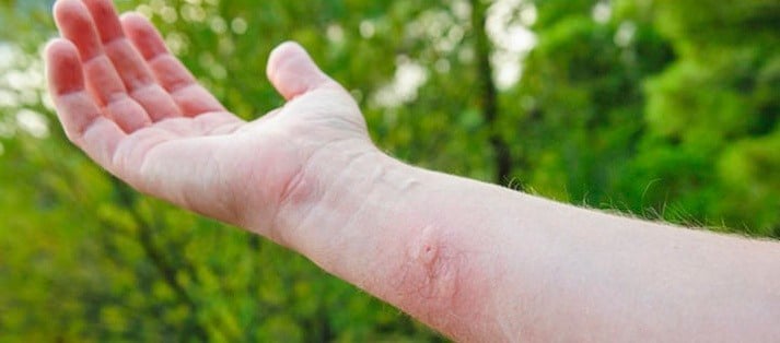 Don’t let the bugs bite… But when you’re bit, this is what you should do.